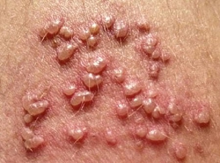 Bị mụn rộp sinh dục có nguy hiểm không? 