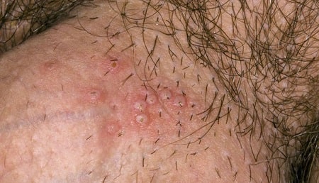 Bệnh mụn rộp sinh dục nam là gì ? 