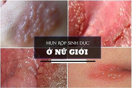 Nguyên nhân bệnh mụn rộp sinh dục nữ như thế nào?