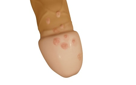 Nhận biết các dấu hiệu mụn rộp sinh dục ở bao quy đầu 
