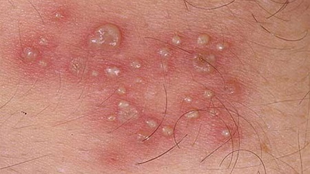 Nguyên nhân mụn rộp sinh dục ở hậu môn