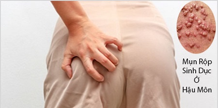 Chẩn đoán herpes hậu môn như thế nào
