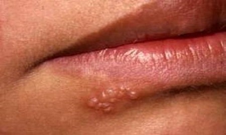 Lây nhiễm mụn rộp sinh dục ở miệng qua những con đường nào?