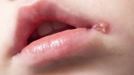 Mụn rộp sinh dục ở miệng nguy hiểm như thế nào ?