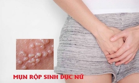 Cách chữa mụn rộp sinh dục ở nữ hiệu quả