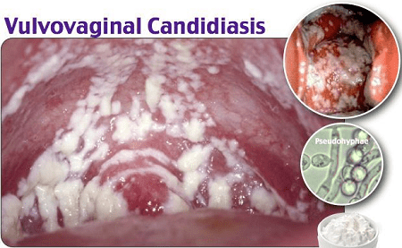 Bệnh nấm candida có nguy hiểm không, biến chứng bệnh như thế nào?