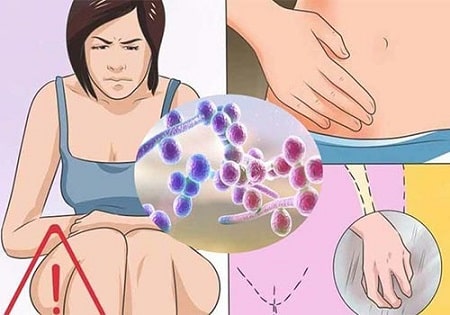 Nấm candida có tự khỏi không ?