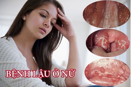Bệnh lậu ở nữ là gì và nguyên nhân do đâu?