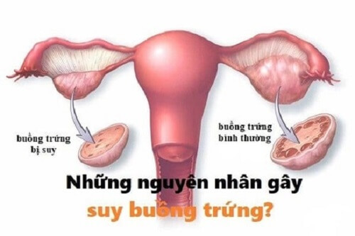 Có nhiều nguyên nhân gây teo buồng trứng