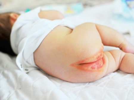 Nguyên nhân gây rò hậu môn ở trẻ sơ sinh - điểm mặt những yếu tố không ngờ