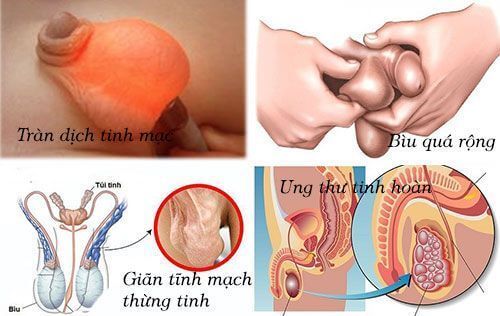 Nguyên nhân khiến tinh hoàn bị nhão, thòng