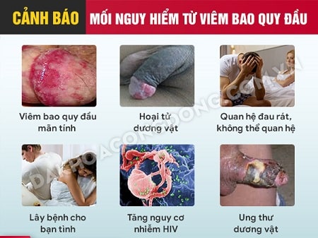 Viêm bao quy đầu có nguy hiểm không?