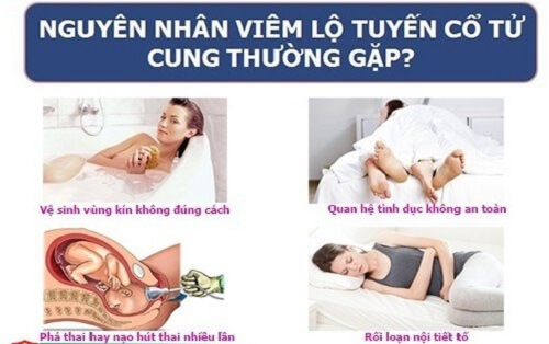 Nguyên nhân gây bệnh viêm lộ tuyến tử cung
