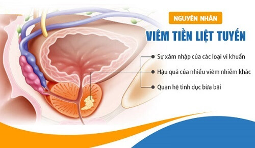 Nguyên nhân viêm tuyến tiền liệt ở nam giới