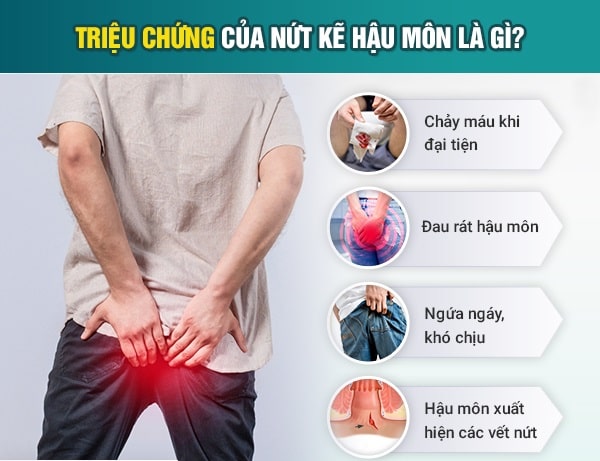 Đâu là triệu chứng điển hình khi mắc nứt kẽ hậu môn