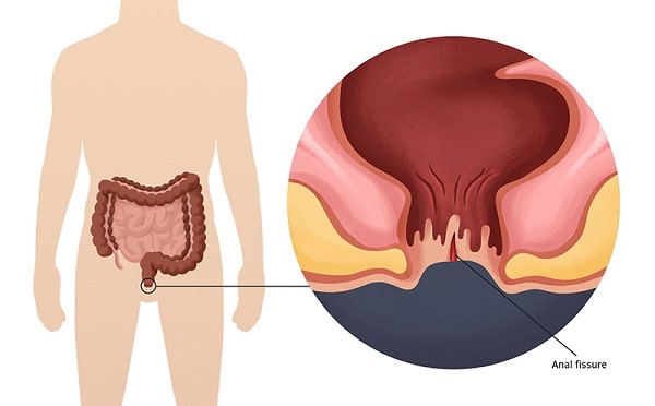 Nứt kẽ hậu môn là gì, những ai dễ mắc bệnh ?