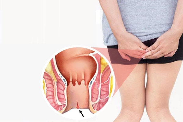 Thế nào là nứt kẽ hậu môn ? Lý do bệnh xuất hiện là gì?