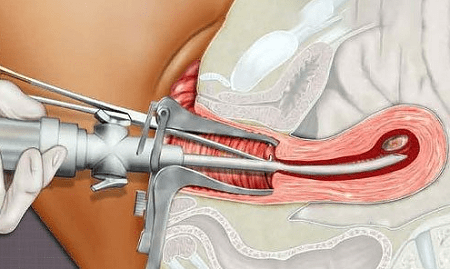 Liệu thực hiện phá thai đau không ?