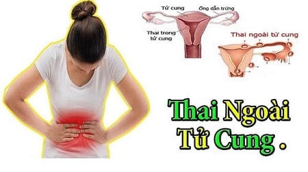 Phá thai ngoài tử cung có tội không ?
