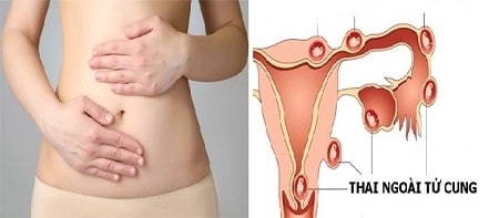 Bị thai ngoài tử cung phải làm sao? 
