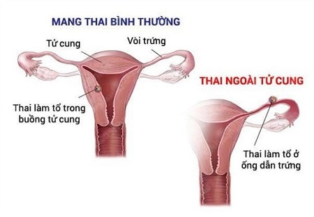 Mang thai ngoài tử cung là gì ?