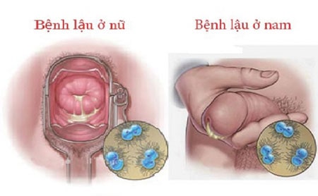 Dấu hiệu nhận biết bệnh lậu ở nam giới và nữ giới