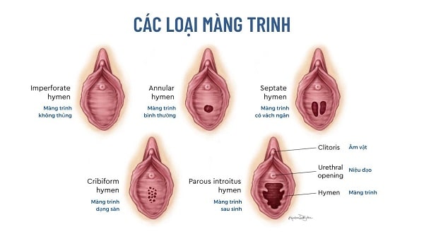 Bạn đã hiểu đúng về phẫu thuật vá màng trinh chưa ?