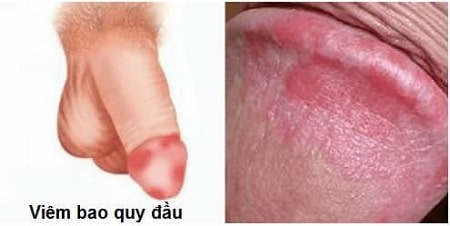 Những thông tin cần biết về bệnh viêm bao quy đầu