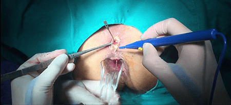 Quy trình mổ rò hậu môn theo đúng tiêu chuẩn y tế
