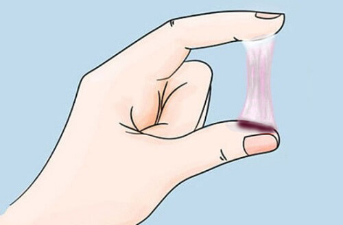 Ra khí hư màu nâu lẫn máu – Cảnh báo ung thư cổ tử cung
