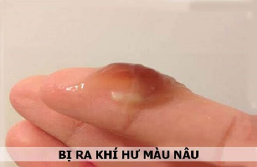 Ra khí hư màu nâu đen