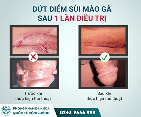 Review đốt sùi mào gà có hiệu quả hay không?