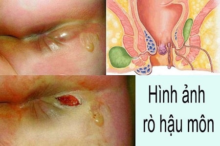 Rò hậu môn là bệnh gì?