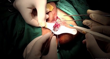 Bệnh rò hậu môn có tự lành không và cách chữa trị