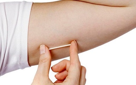 Cấy que tránh thai có tác dụng gì?
