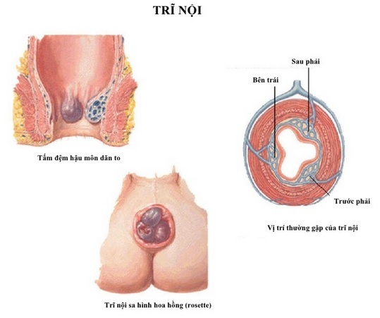Sa nghẹt hậu môn