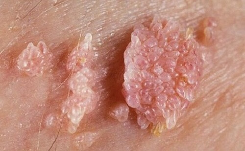 Bị nổi mẩn ngứa ở vùng kín nữ và nam do sùi mào gà