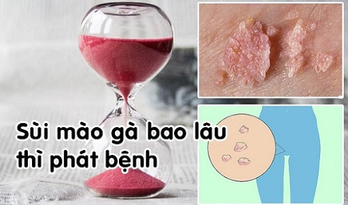 Sùi mào gà phát bệnh sau khoảng 3 tuần- 9 tháng