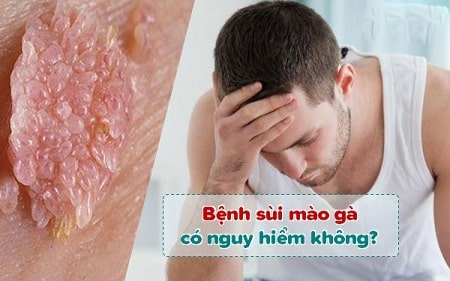 Bệnh sùi mào gà không điều trị sớm có nguy hiểm không?