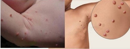 Bệnh sùi mào gà ở nách có nguy hiểm không?