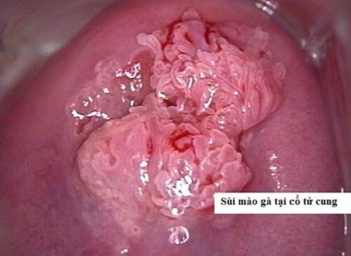 Sùi mào gà cổ tử cung