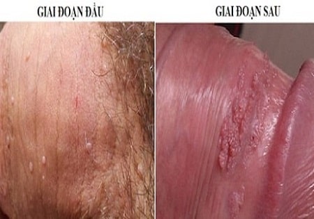Nguyên nhân gây sùi mào gà ở bộ phận sinh dục