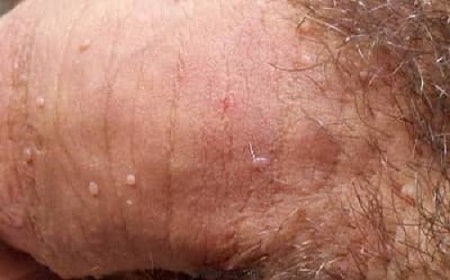 Triệu chứng nhận biết bệnh sùi mào gà ở “cậu nhỏ”