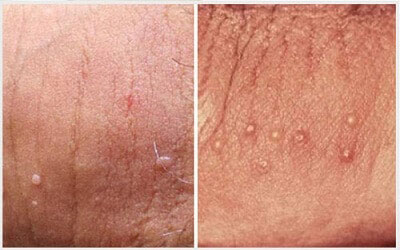 Sùi mào gà ở dương vật nam giới