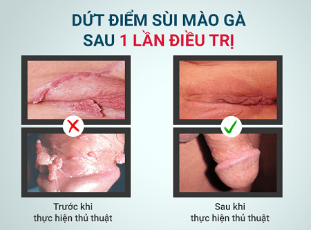 Điều trị sùi mào gà giai đoạn đầu hiệu quả cao tại Đa khoa Quốc tế Cộng đồng