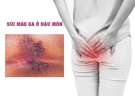 Nguyên nhân gây ra sùi mào gà ở hậu môn