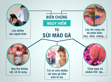 Sự nguy hiểm của bệnh sùi mào gà nếu chữa muộn