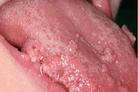Những ai dễ mắc bệnh sùi mào gà nhất ?
