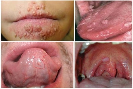 Miệng, lưỡi có xuất hiện sùi mào gà