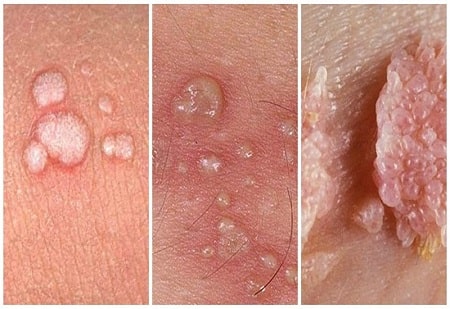 Những thông tin tổng quan về bệnh sùi mào gà cần biết